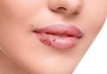 Come eliminare un Herpes labiale